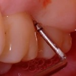 Gum disease check