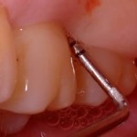 gum disease probe