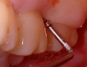 gum disease probe