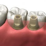 double dental implant