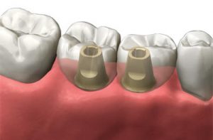 dois implantes dentários